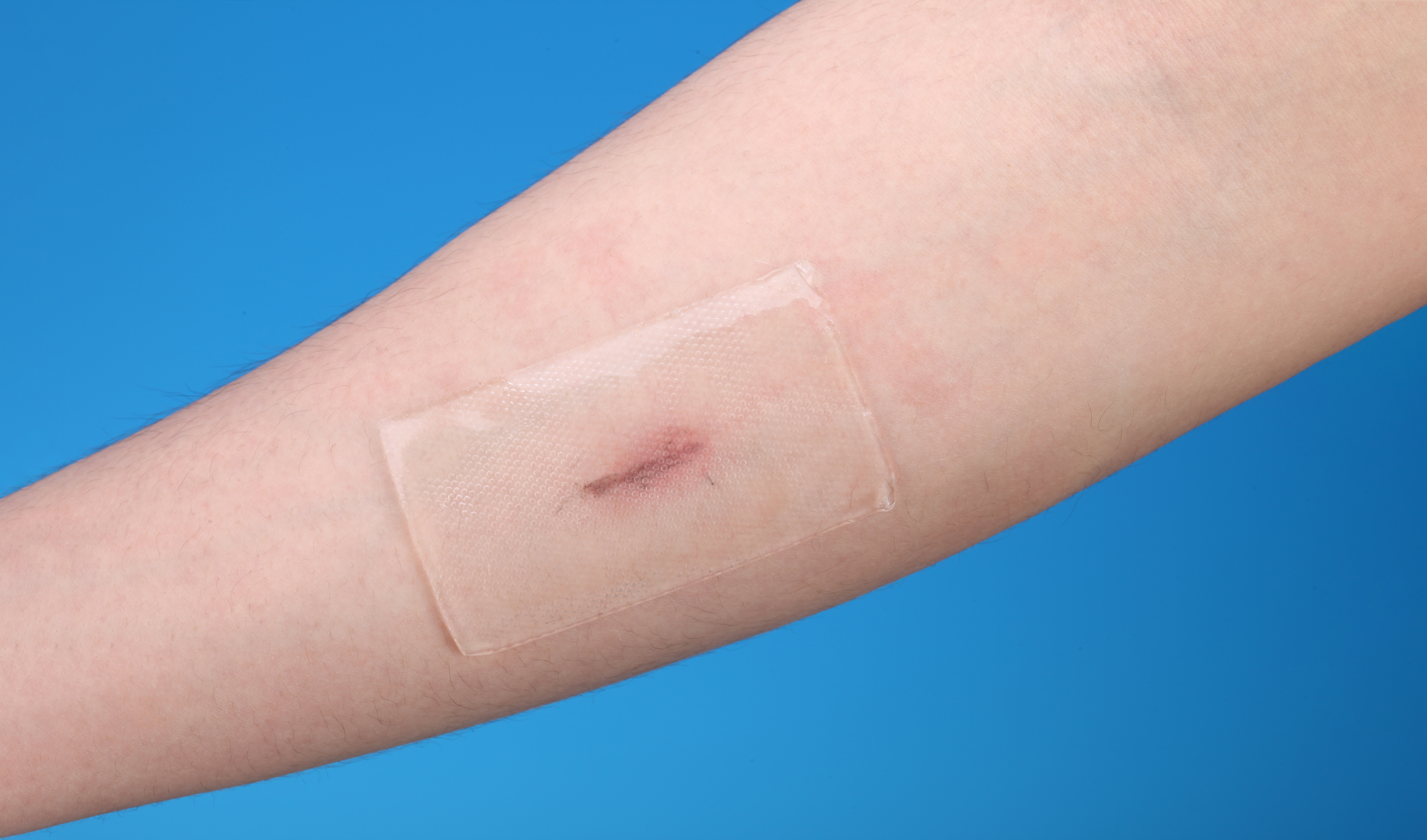 Perubatan FDA meluluskan pelekat Silicone Scar Dressing